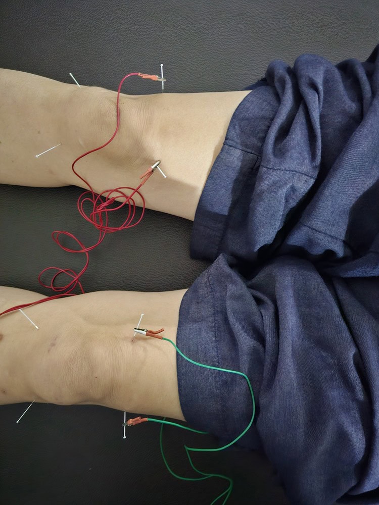 a close up of my knees and acupuncture at Nirvana Naturopathy Retreat